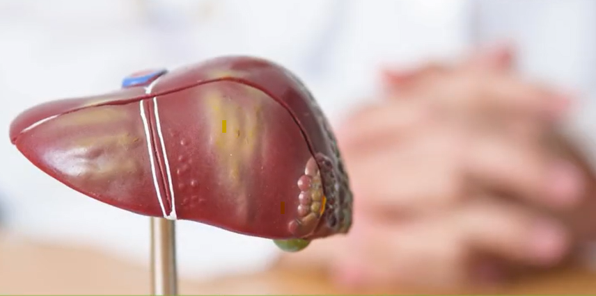 ما هو مرض PFIC؟