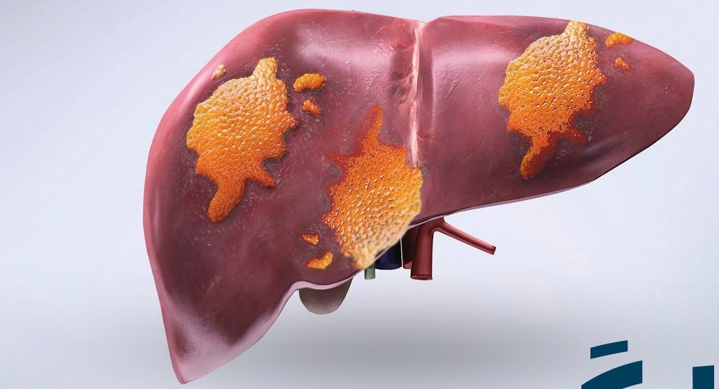 الكبد الدهني والدهني الكحولي